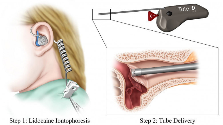 Ear Tube Devices Are Primarily Used To Treat Infections While Also Assisting In The Drainage Of Pus And Mucus Buildup Inside The Ear