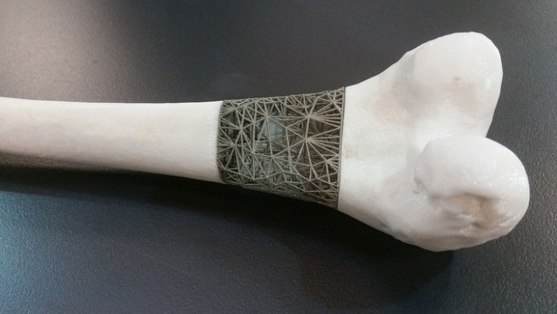3D Printed Medical Implants Market Size Share Trends Forecast 2026