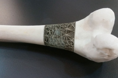 3D Printed Medical Implants Market Size Share Trends Forecast 2026