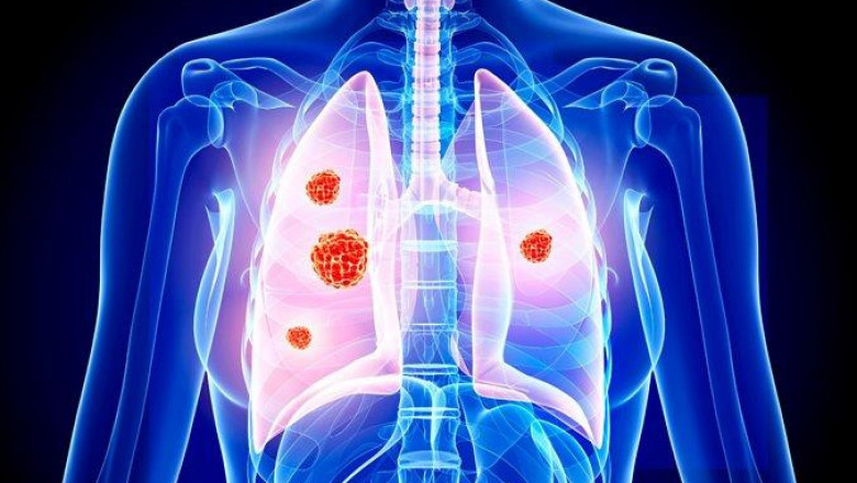 Small Cell Lung Cancer Therapeutics Market Opportunity Analysis-2026