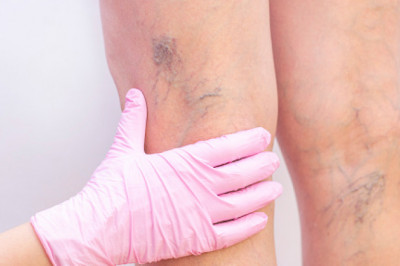 How to get rid of spider veins