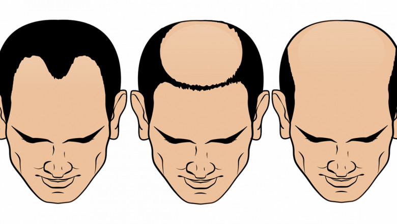 Reasons to Avoid Hair Transplant in Teenagers