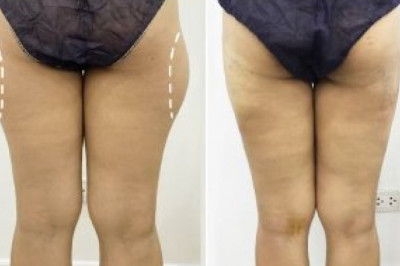 VASER Liposelection - The subsequent Gen in Physique Contouring