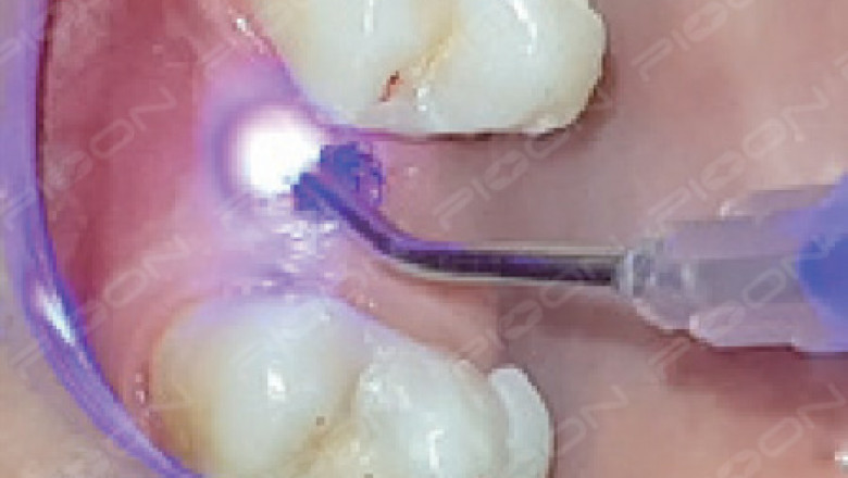 How do implant doctors use dental laser effectively