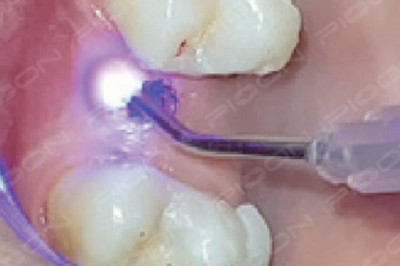 How do implant doctors use dental laser effectively