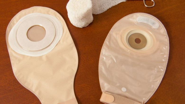 Colostomy Bags Market Size, Share, Outlook, and Opportunity Analysis, 2019– 2027
