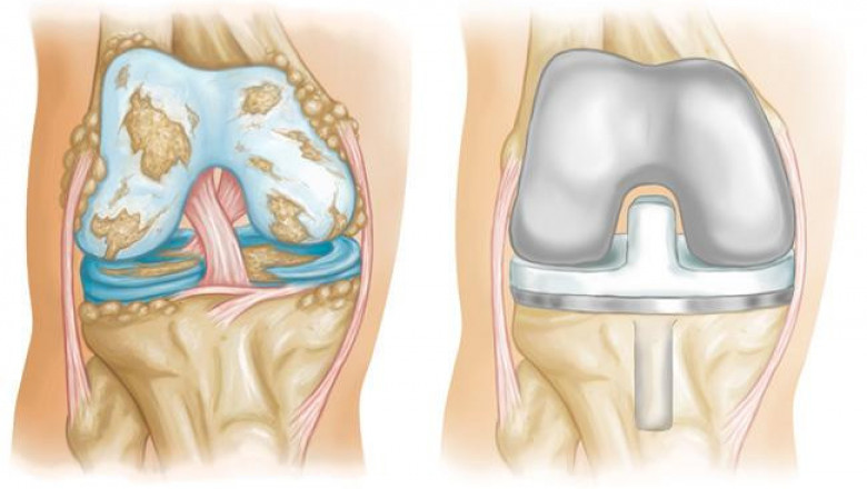Knee Implants Market Size, Share, Outlook, and Opportunity Analysis, 2018– 2026