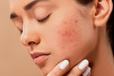 Acne Diet Plan Get Rid of Acne by Eating Healthier