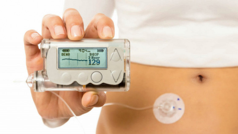 Insulin Pumps Market Size, Share, Outlook, and Opportunity Analysis, 2018– 2026