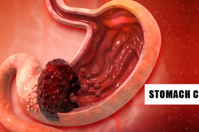 Stomach/Gastric Cancer Treatment in Gurugram, Gurgaon, Haryana, Delhi