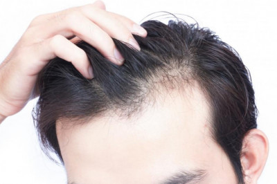 Does PRP Treatment Work For Hair Loss And Is It Safe?