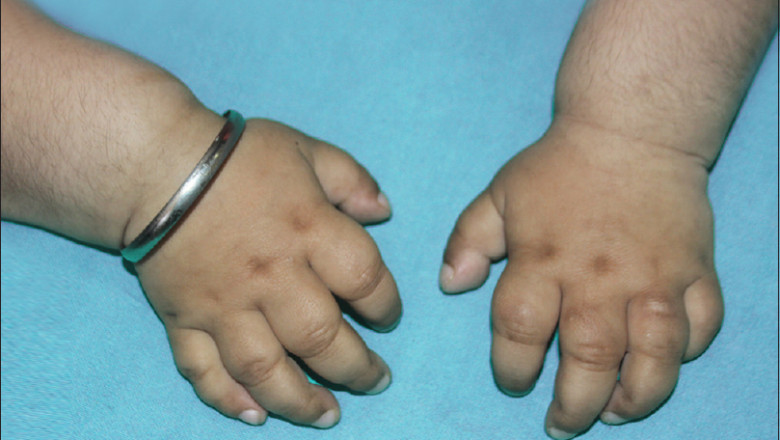 Hunter Syndrome is a psychological condition that affects people The patient's age and the seriousness of the disease determine the treatment plan