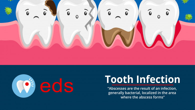 Tooth Infection Treatment | Emergency Dental Service