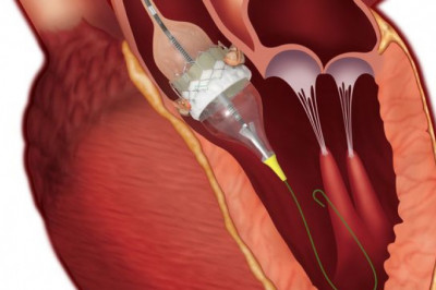 Transcatheter Heart Valve Implantation Is A Minimally-Invasive Procedure To Repair Damaged Heart Valves