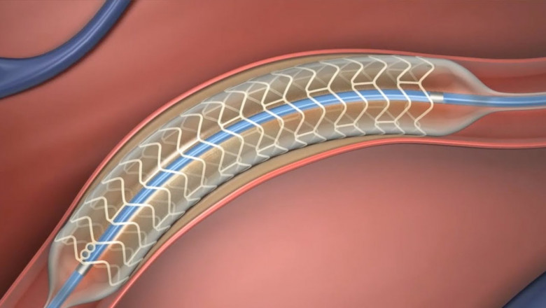 In the field of clinical innovation bioabsorbable stents are among the freshest developments