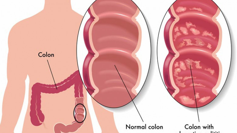 Ulcerative Colitis Market Size, Trends, Shares, Insights and Forecast – 2018-2026