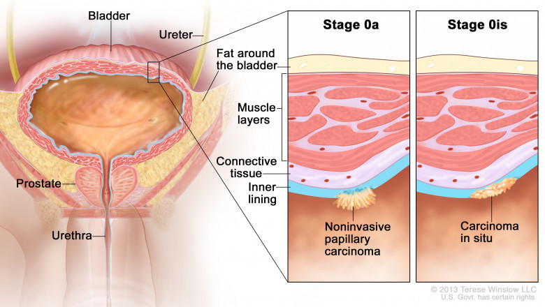 The Urothelial Cancer Treatment Involves Surgery, Chemotherapy And Radiotherapy