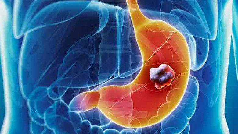 Gastric Cancer Therapeutics Market Size, Trends, Shares, Insights and Forecast – 2018-2026