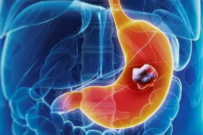 Gastric Cancer Therapeutics Market Size, Trends, Shares, Insights and Forecast – 2018-2026