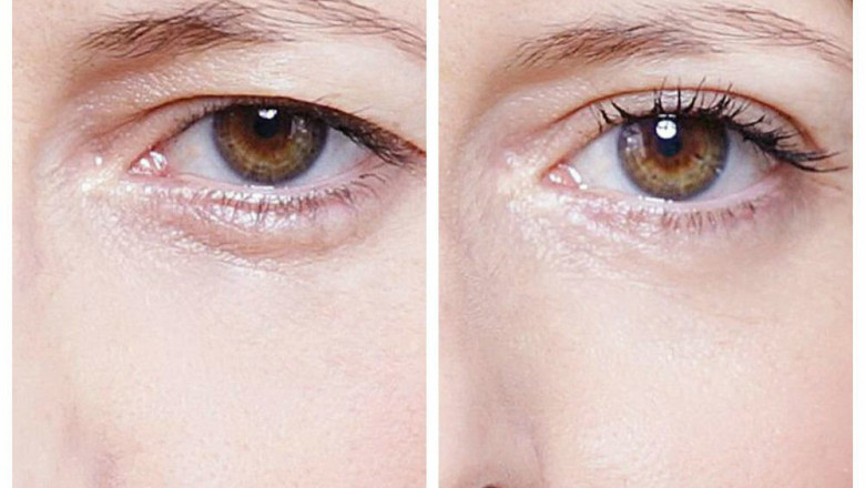 Obtainable Options for Reduce Blepharoplasty