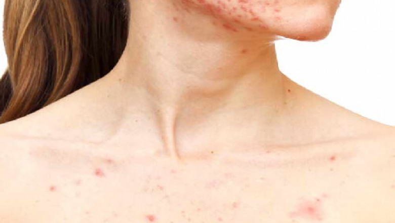 Choose the best acne skin treatment solution