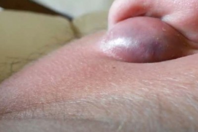 Cyst Behind Ear Explodes | New Pimple Popping Videos
