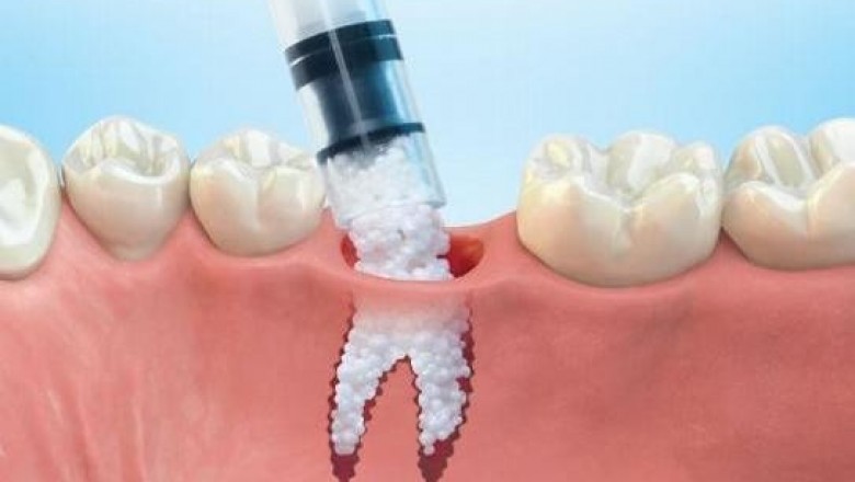 Tooth Regeneration Market To Surpass 5,980 Million Dental Procedures By 2027 - Coherent Market Insights