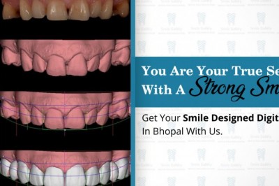 Root canal Treatment cost in bhopal