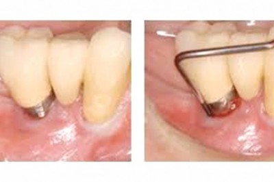 One of the most classic periodontal treatment options