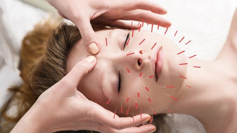 How Does Chinese Acupuncture Work?