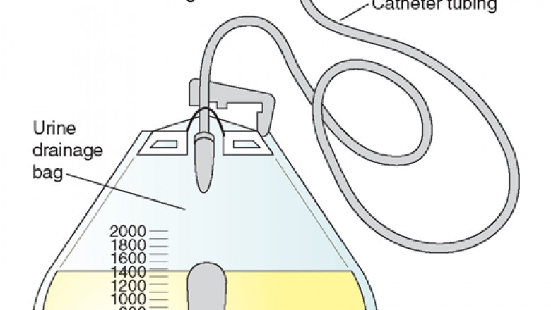 Purple Urine Bags Infection, A Dramatic And Alarming Medical Phenomenon