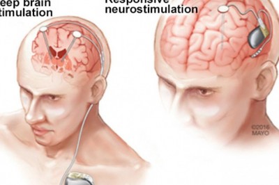 Neurostimulation Devices Market is set to witness massive growth by 2022