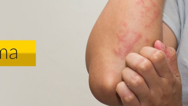 Eczema Treatment in Dwarka