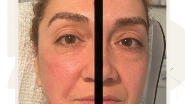 Benefit of Botox treatment in Phoenix