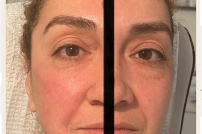 Benefit of Botox treatment in Phoenix
