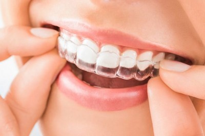 Clear Aligners; an Alternative to Traditional Braces without Metal Wire or Brackets