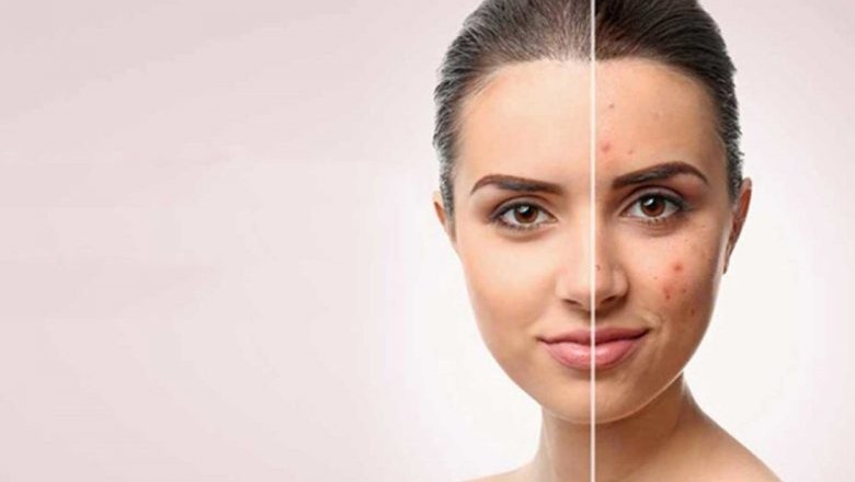 The North America scar treatment is growing due to an increase in the number of accidents.