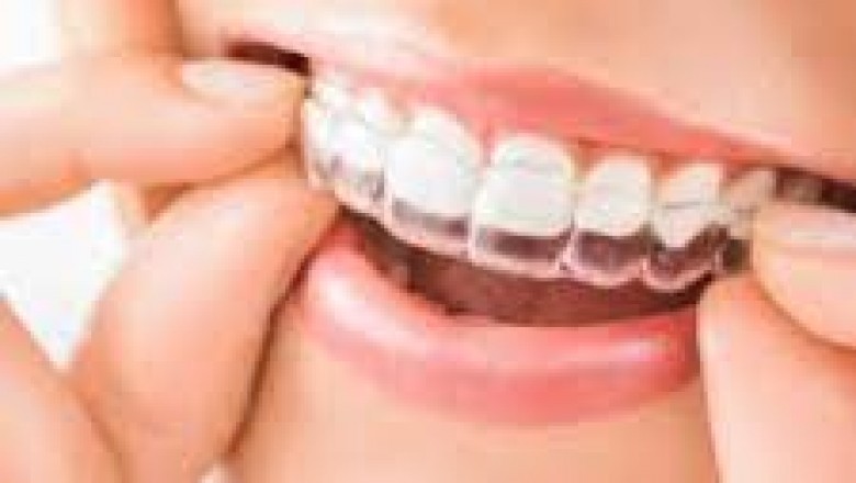 How to Maintain Your Invisalign?