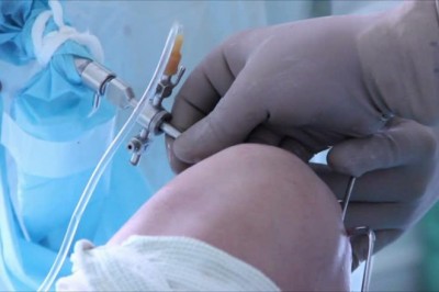 The Demand for Arthroscopy Devices Has Increased Due to Increasing Prevalence of Musculoskeletal Disorders