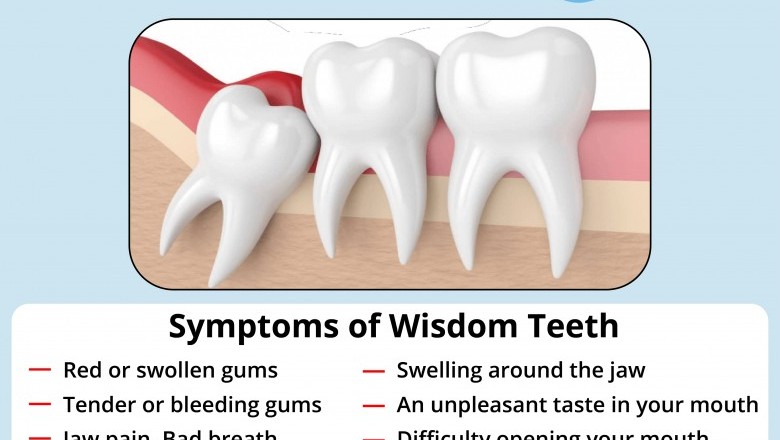 Symptoms of Wisdom Teeth | Best Emergency Dentist