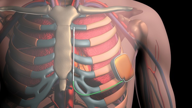A small electronic device attached to the heart is known as an implantable cardioverter-defibrillators (ICD).