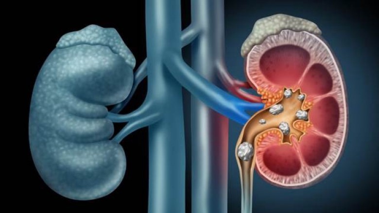Urolithiasis Management Devices Are Used To Treat Urolithiasis, A Painful Condition Characterized By The Development Of Stones Or Calculi In The Urinary Tract