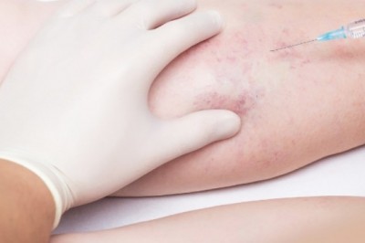 Advantage Of Microsclerotherapy Treatment Is That It Is Effective In Treatment Of A Wide Variety Of Pain