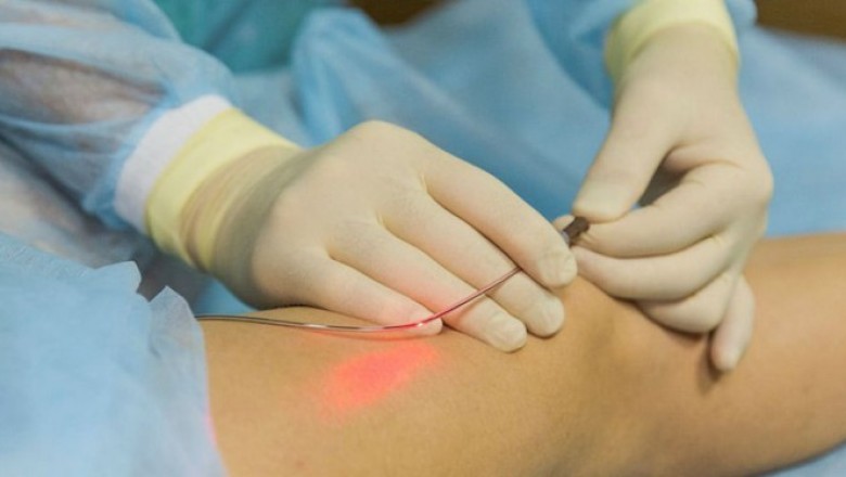 Endovenous Laser Therapy Market Size, Trends, Shares, Insights and Forecast – 2018-2026