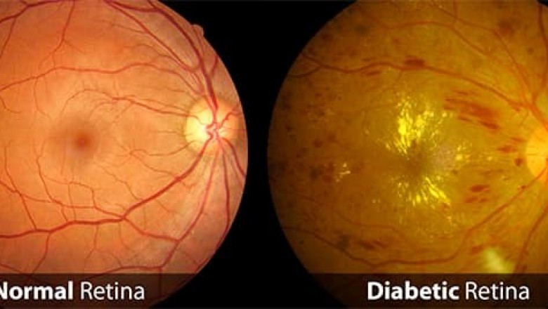 Diabetic Retinopathy Market Size, Trends, Shares, Insights and Forecast – 2018-2026
