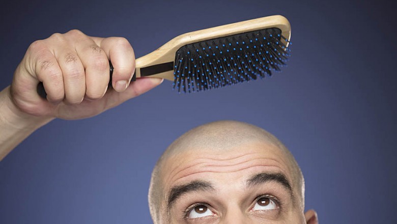 Considering a Hair Transplant?