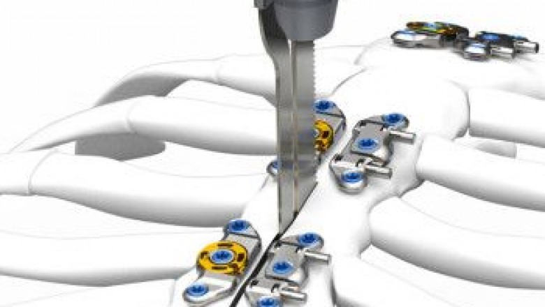 Sternal Closure Systems Market trends and insights