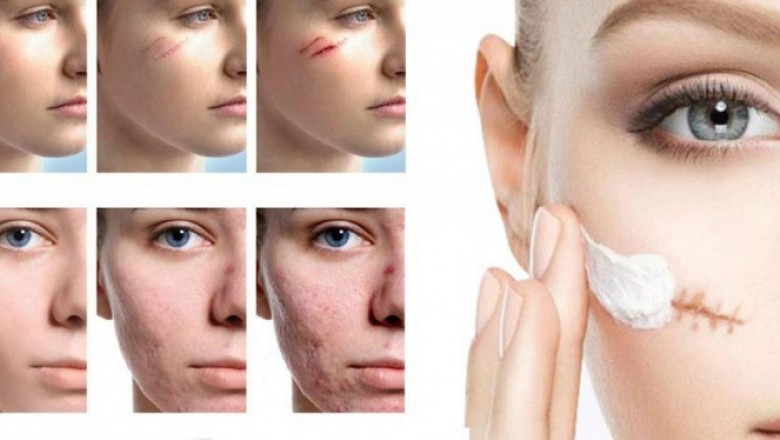 China Scar Treatment Market To Surpass US$ 5,317.7 Million By 2027