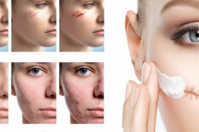 China Scar Treatment Market To Surpass US$ 5,317.7 Million By 2027