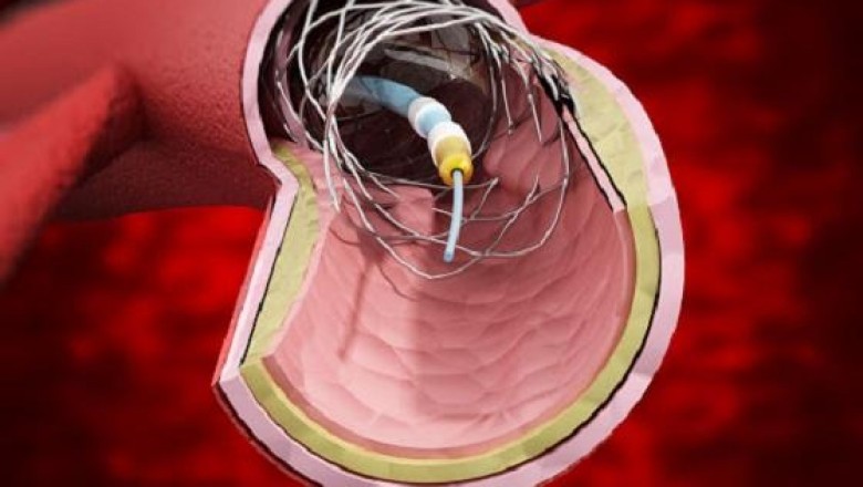 Global abdominal aortic aneurysm repair devices market is likely to grow significantly over the forecast period.
